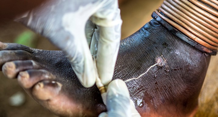 Photo: A health worker extracts a Guinea worm from a person's foot in Eastern Equatoria (Courtesy/Carter Center)