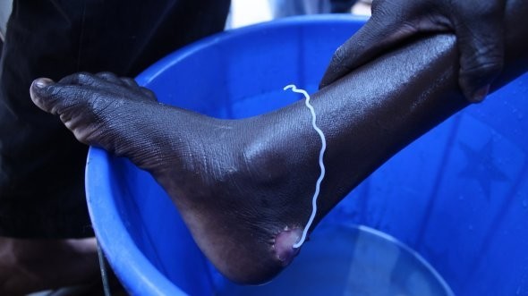 Guinea worm emerging from the foot of a patient in South Sudan (Credit: Makoy S. Yibi)